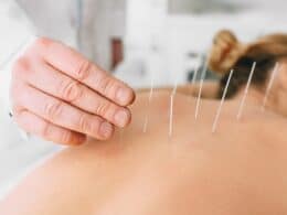 Terapias de acupuntura
